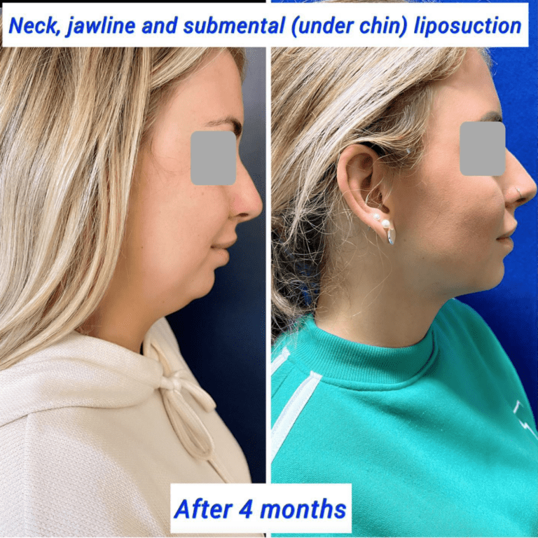 jawline liposuction jawline liposuction
