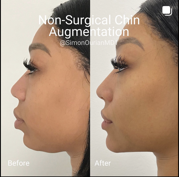 jawline liposuction jawline liposuction