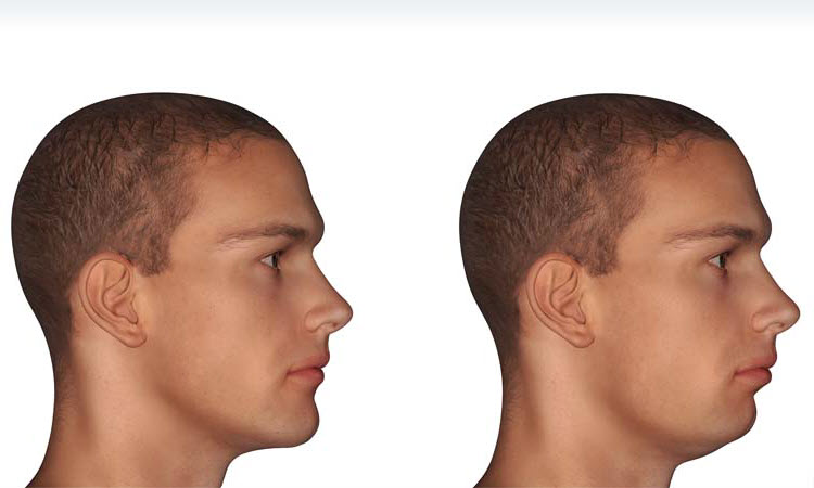 Jawline plastic surgery: Achieving a sharper, more defined profile