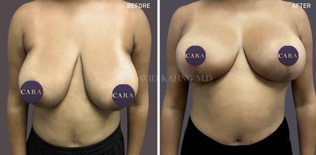 laser breast lift