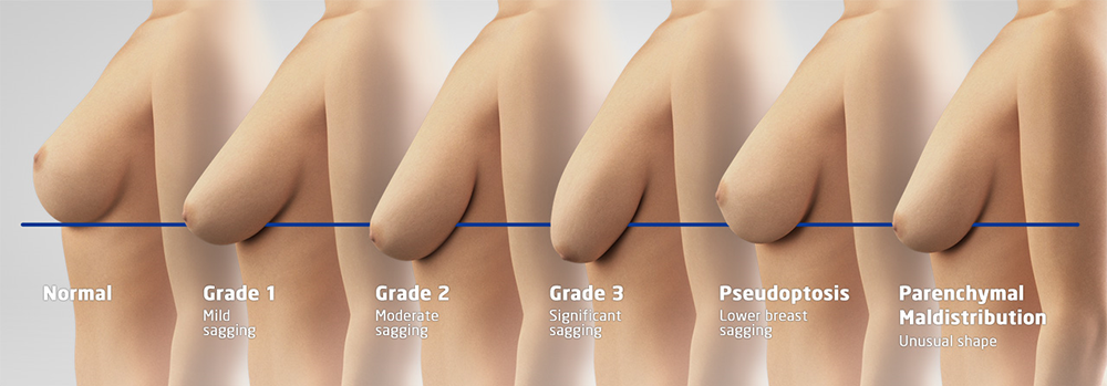 laser breast lift