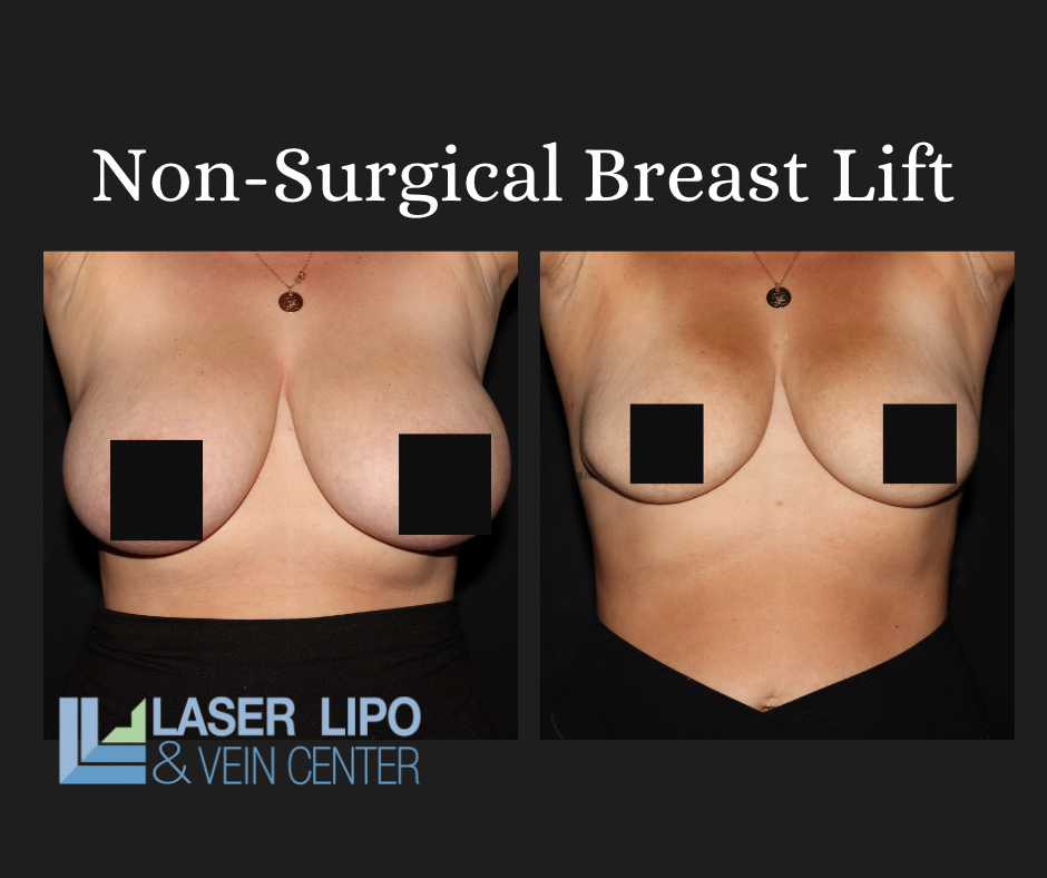 laser breast lift