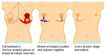 Laser breast lift: Innovative technology for breast enhancement