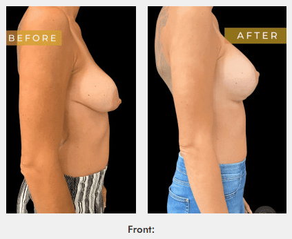 laser breast lift
