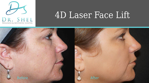 laser face lift