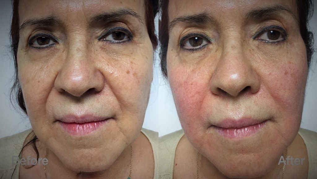 laser face lift