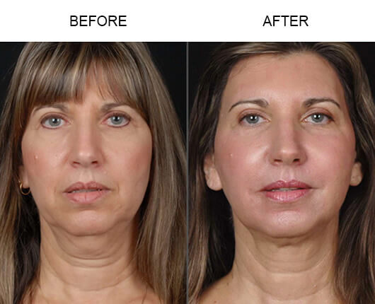Laser facelift: Advanced technology for skin tightening