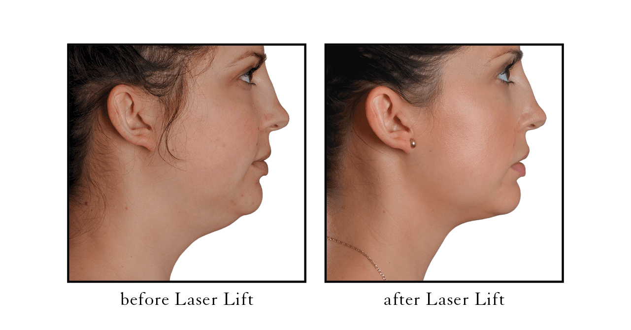 laser face lift