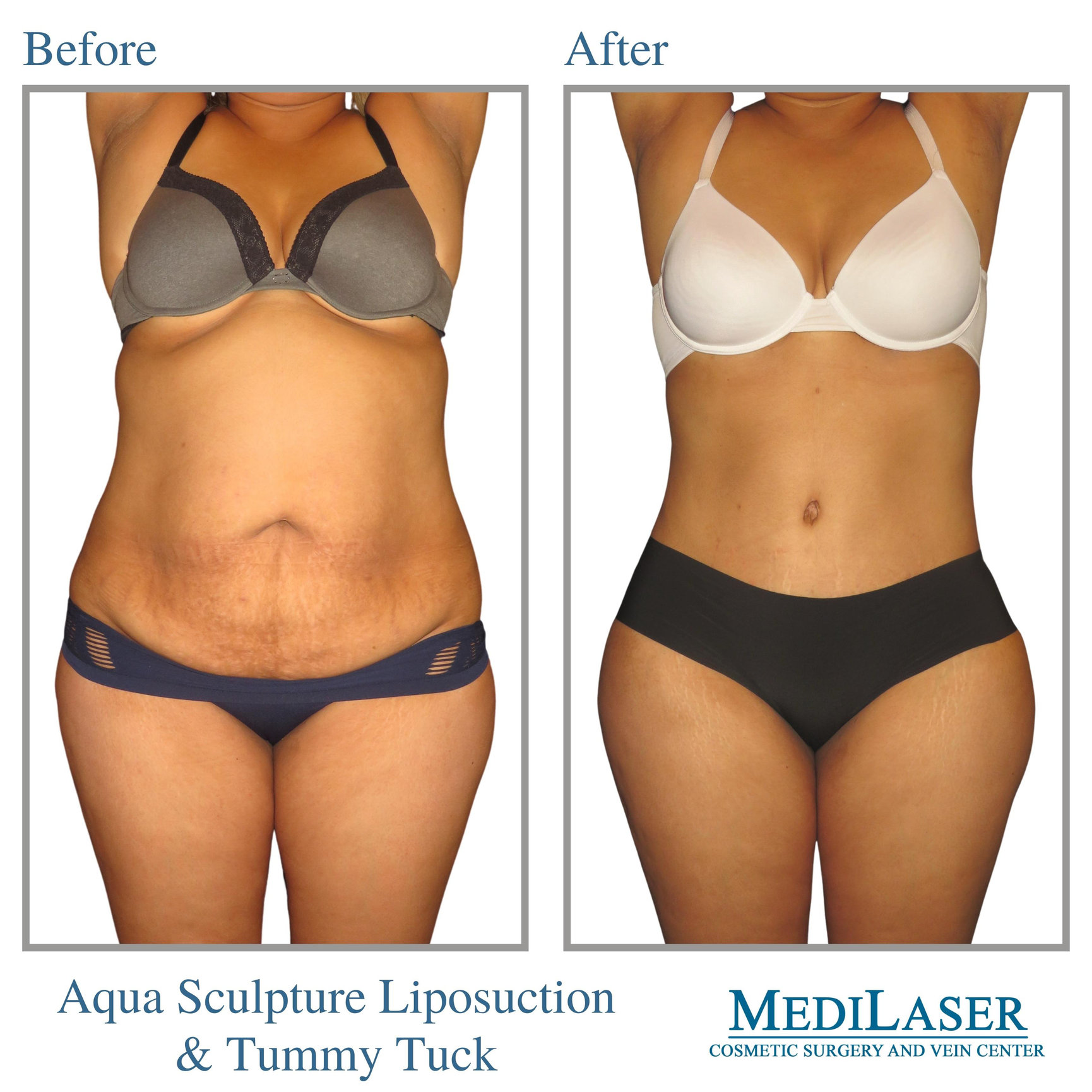 laser tummy tuck laser tummy tuck