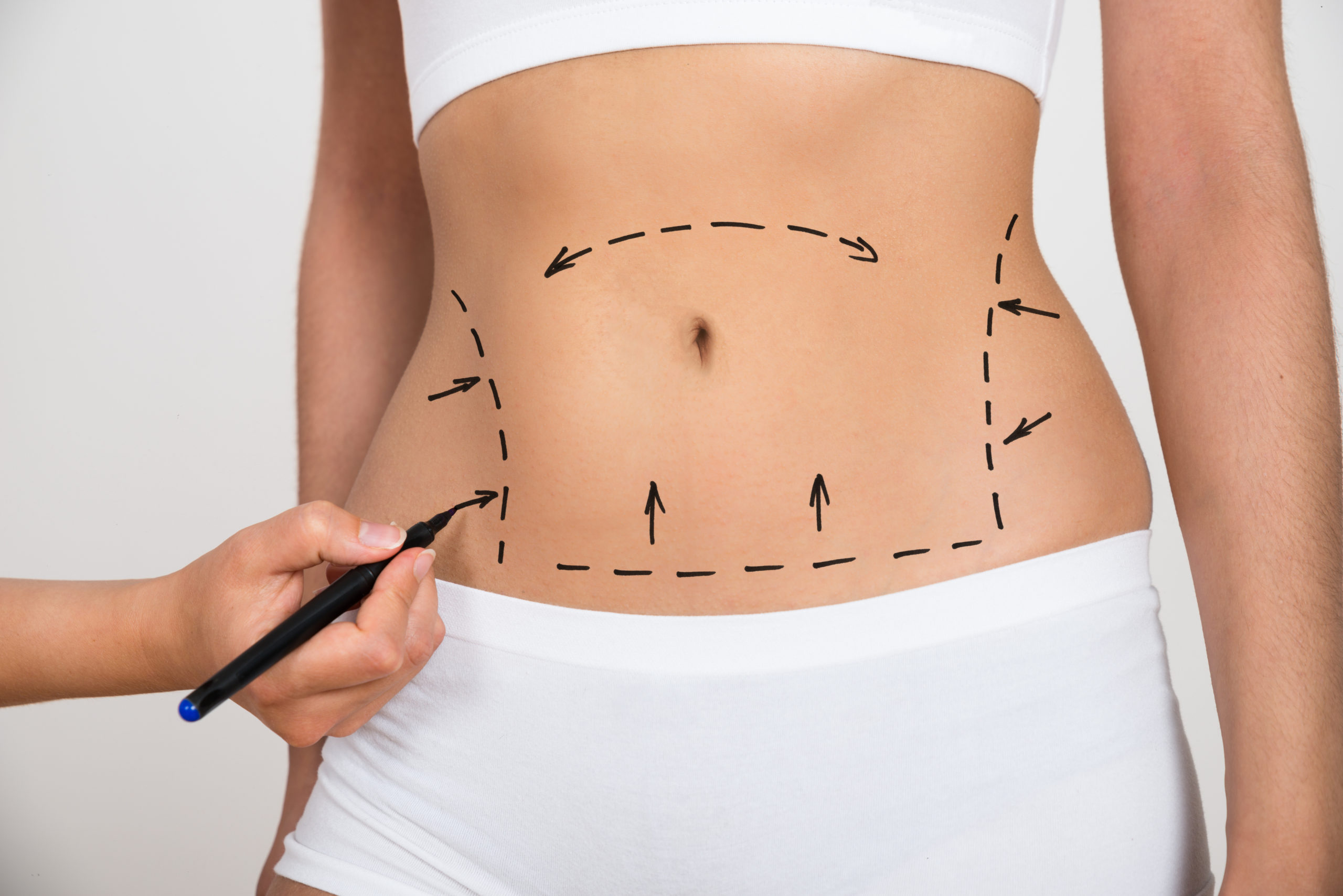 laser tummy tuck laser tummy tuck