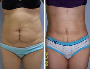 laser tummy tuck laser tummy tuck