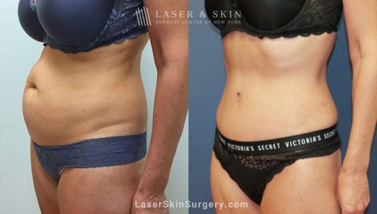 Laser Tummy Tuck: Minimally invasive reshaping