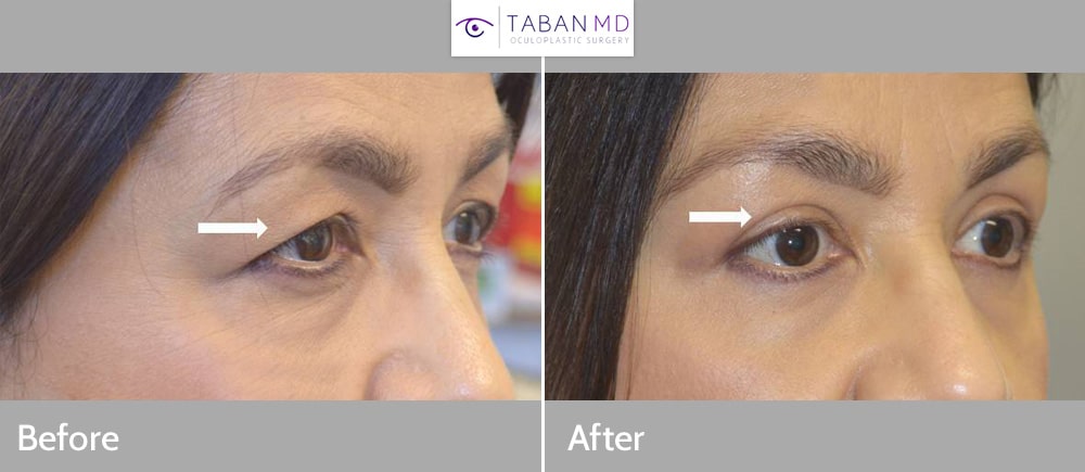 lateral brow lift