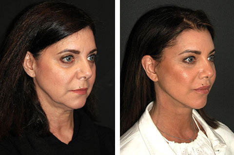 Lateral brow lift: Elevating the outer brow for a youthful appearance
