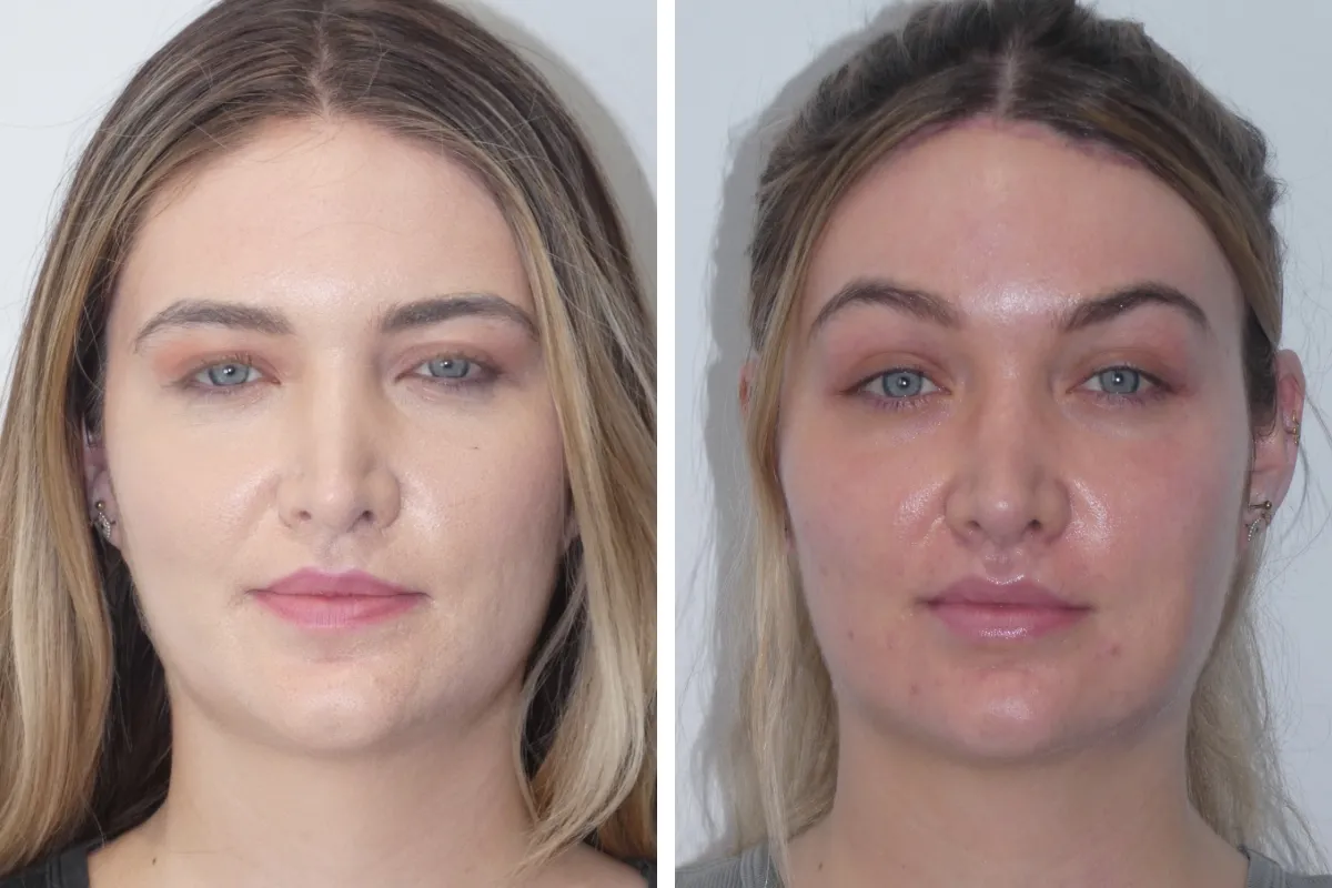 lateral brow lift