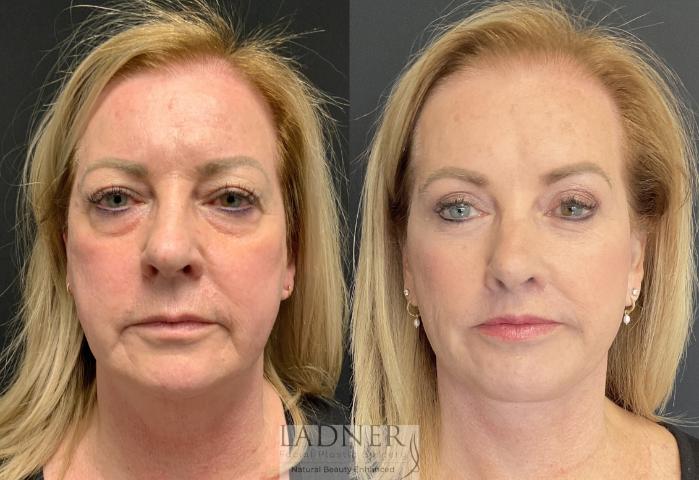 lift plastic surgery