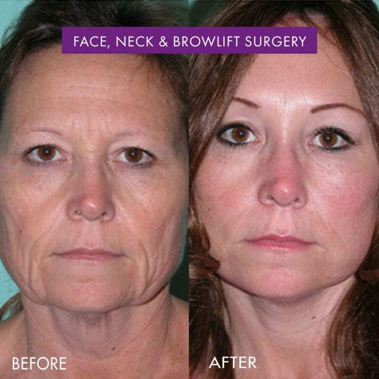 lift plastic surgery