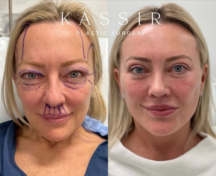 Lift Plastic Surgery: Elevating confidence