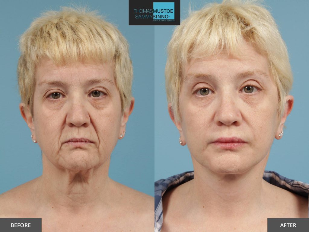 lift plastic surgery