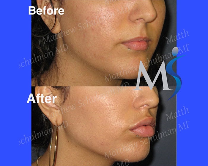 lip augmentation