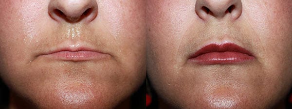 lip augmentation