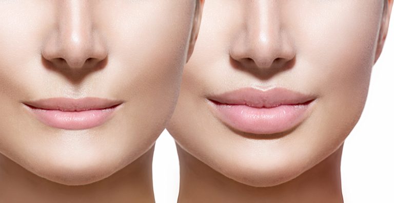 Lip Augmentation: Enhancing fullness and symmetry