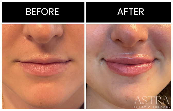 lip augmentation surgery