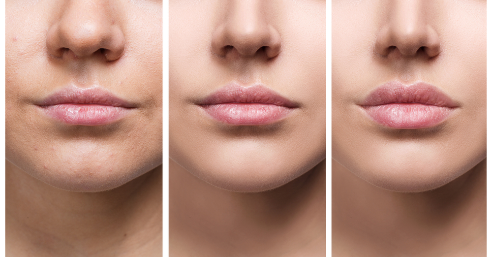 lip augmentation surgery