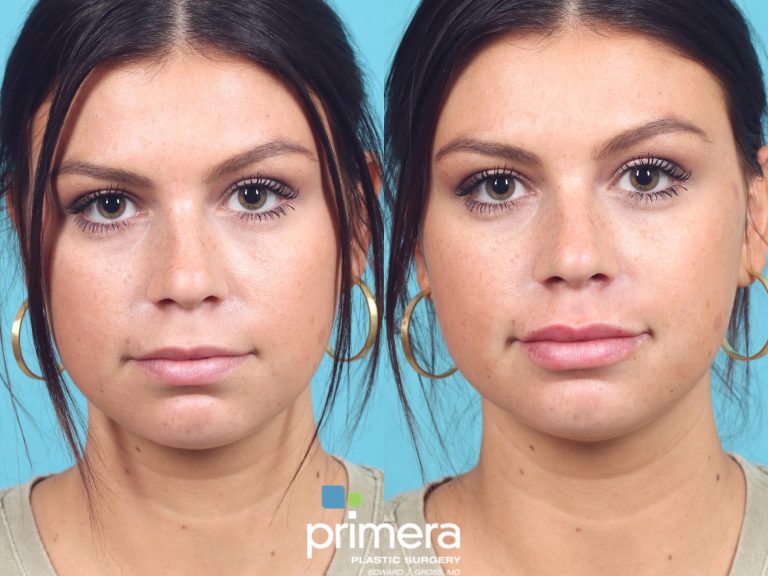 Lip augmentation surgery: Enhancing fullness and symmetry