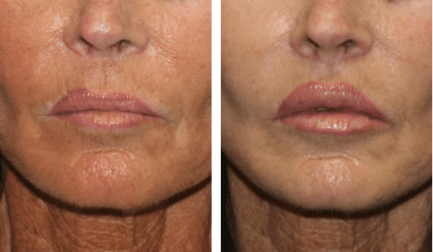 lip augmentation surgery