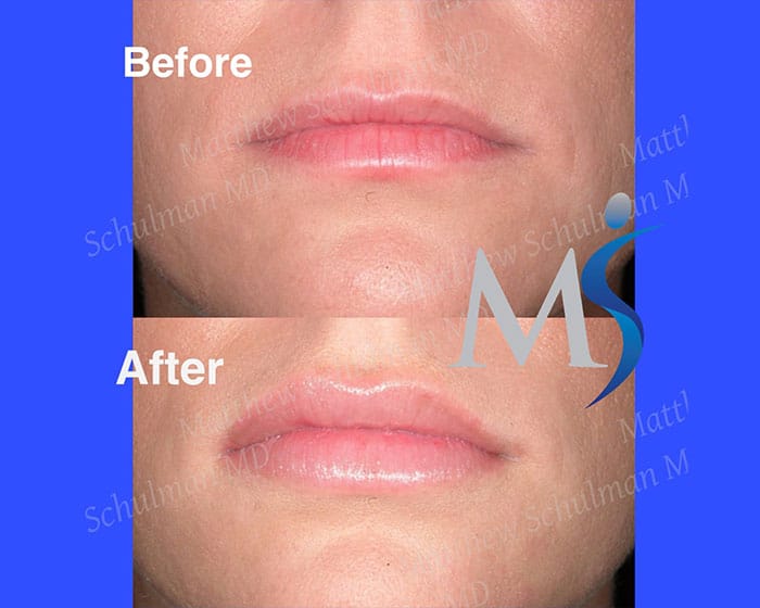 lip implants cost lip implants cost