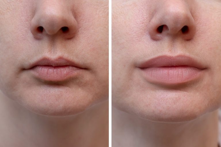 Lip implants cost: Adding volume and shape to your lips