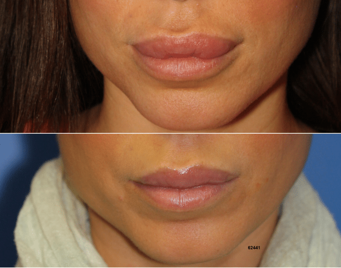 lip implants cost lip implants cost