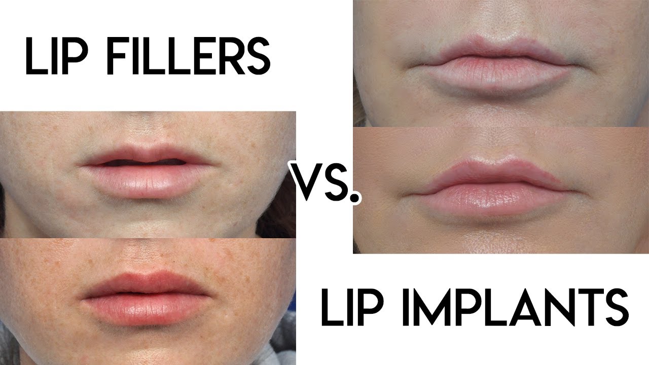 lip implants