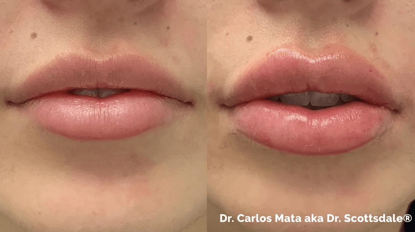 lip implants
