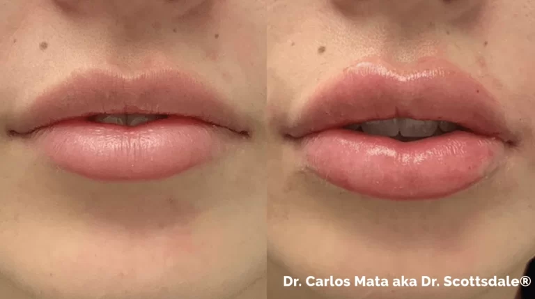 Lip implants: Options for fuller, shapely lips