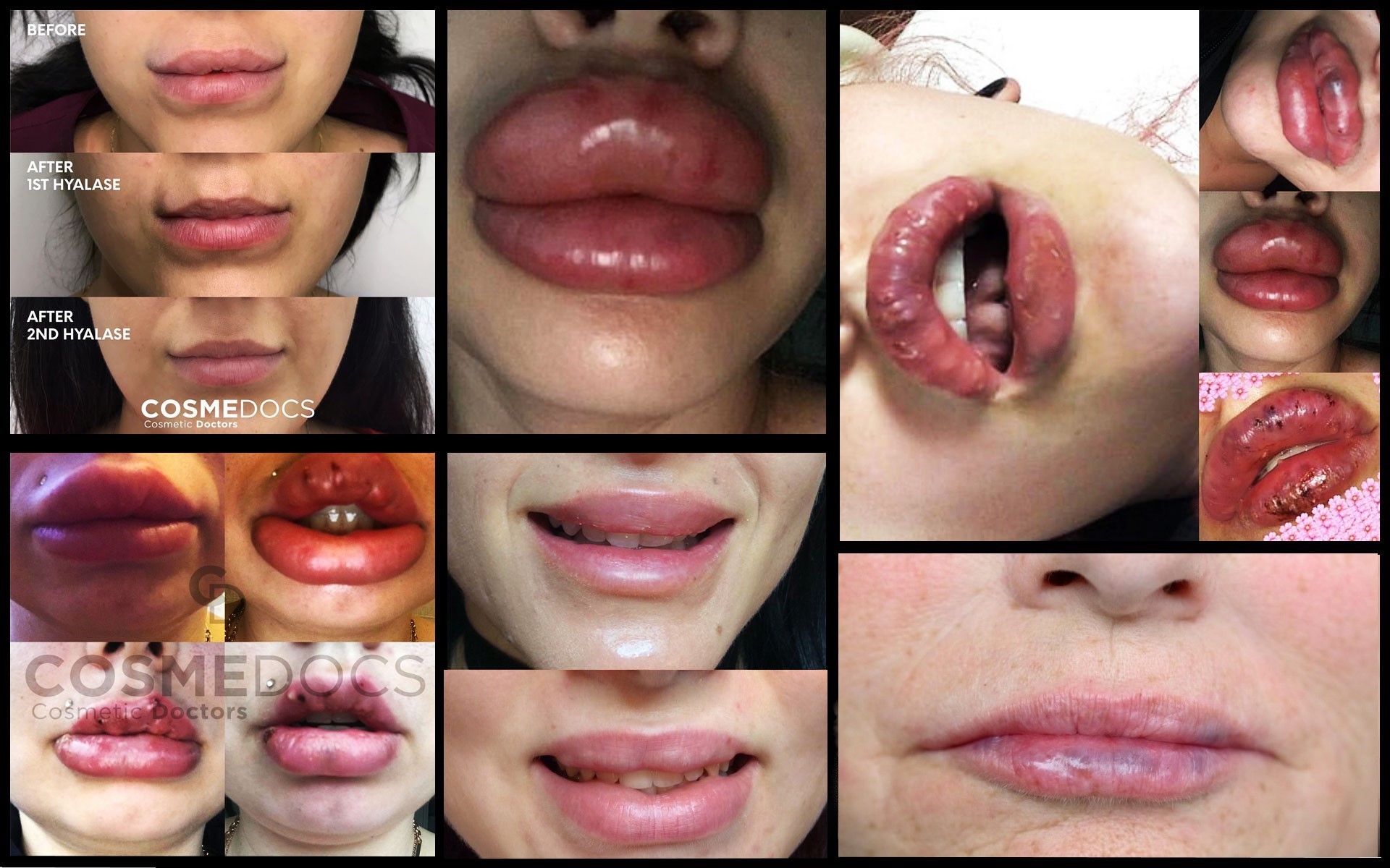 lip implants