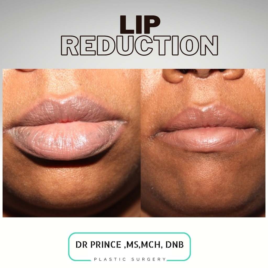 lip plastic surgery lip plastic surgery