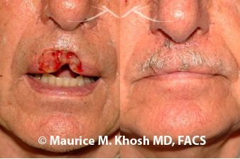 lip reconstruction