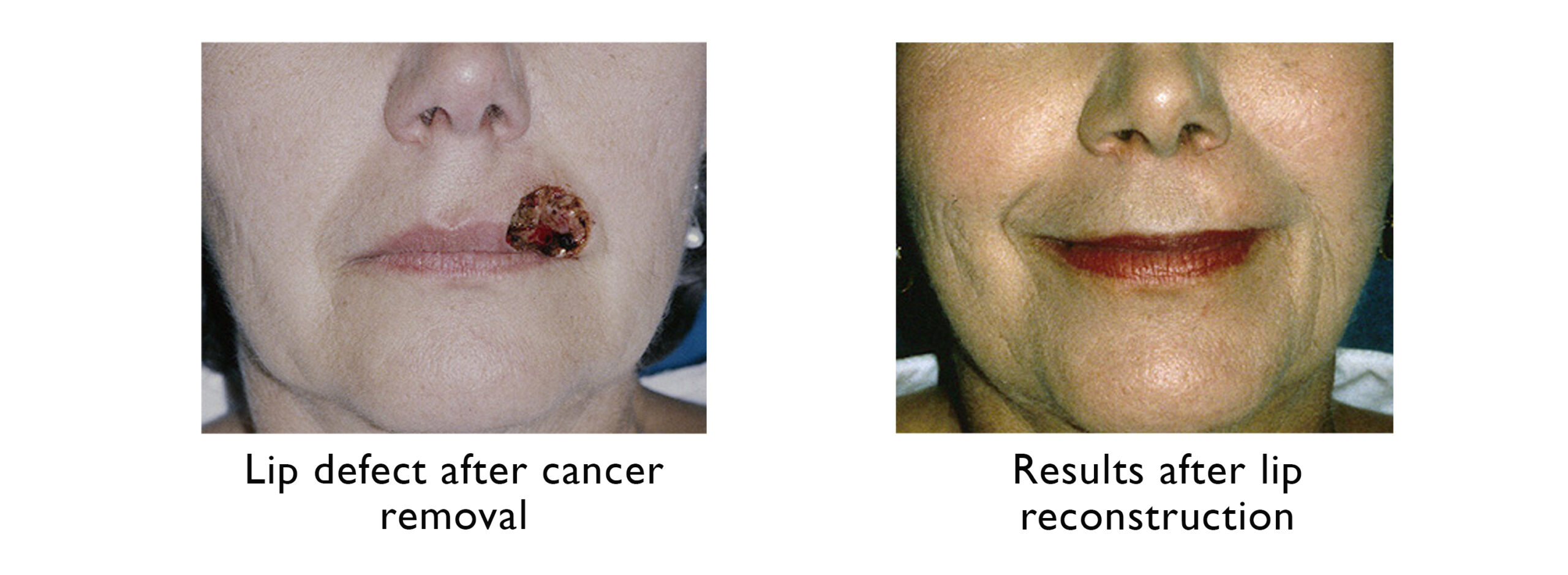 lip reconstruction