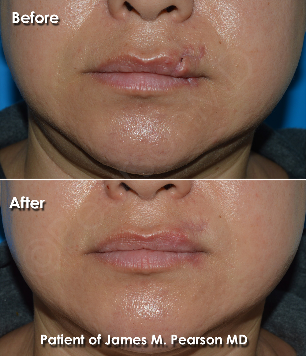 lip reconstruction surgery
