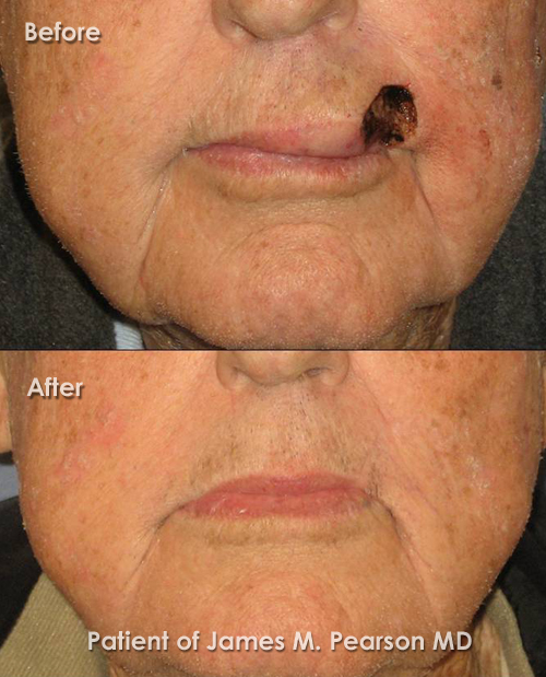 lip reconstruction surgery