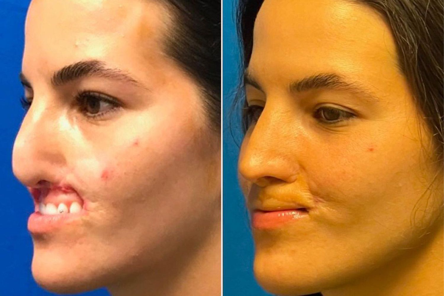lip reconstruction surgery