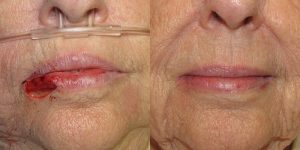 Lip Reconstruction Surgery: Restoring function and aesthetics