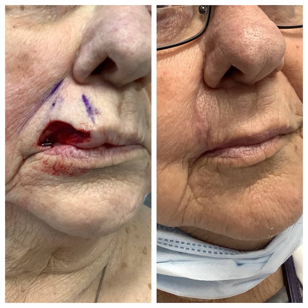 lip reconstruction surgery