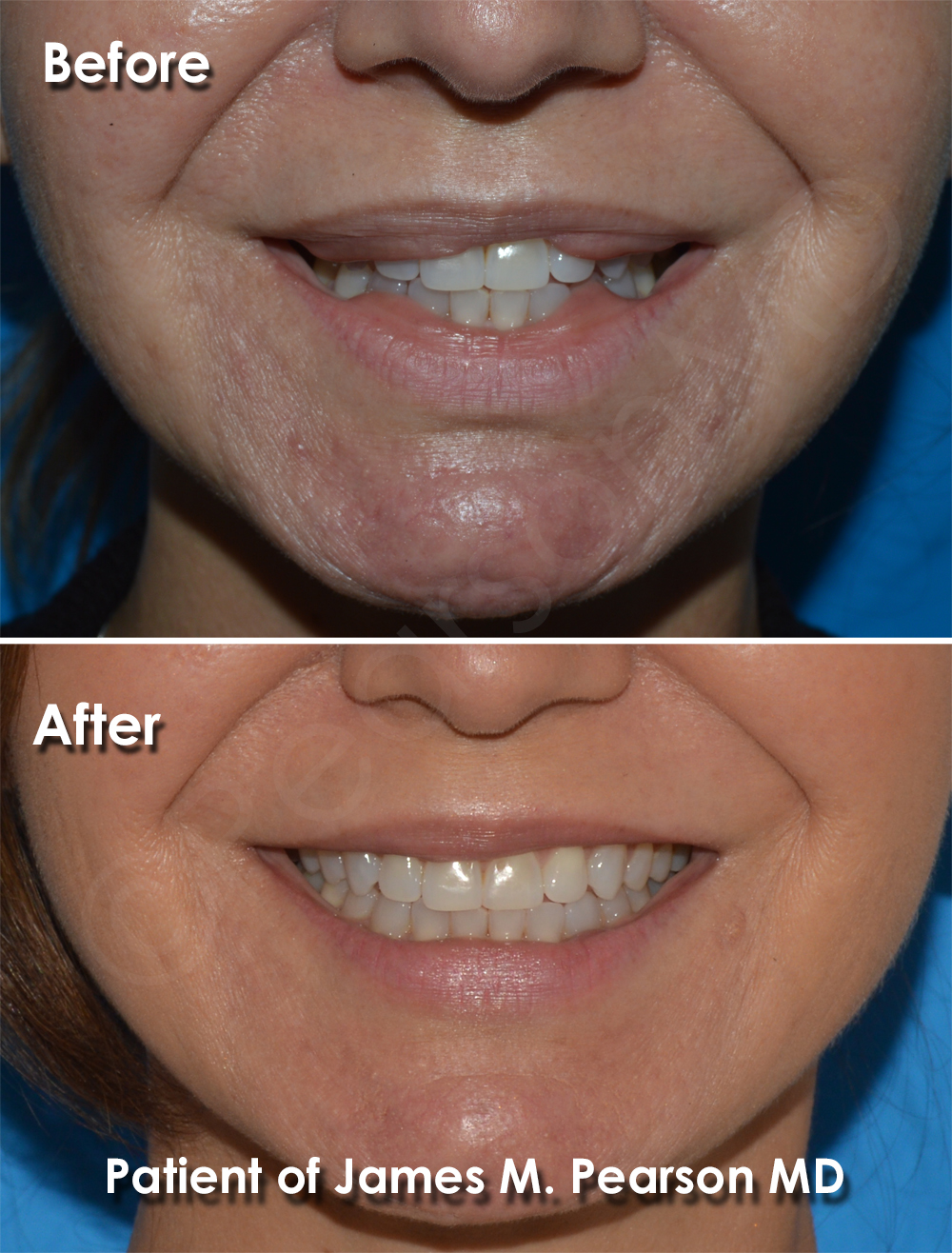 lip reduction