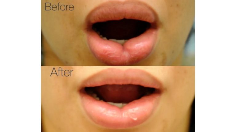 Lip Reduction: Refining shape and size