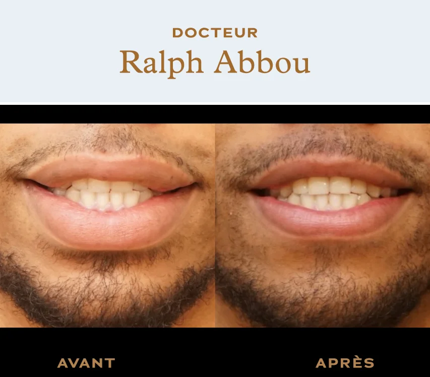 lip reduction