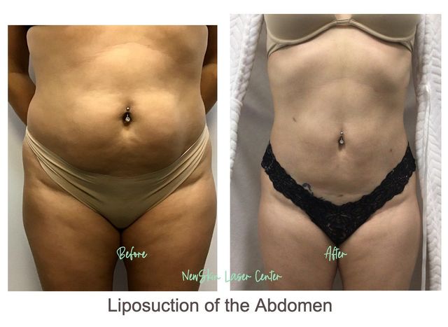 lipo cost lipo cost
