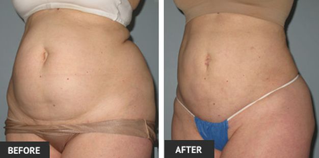 lipo cost lipo cost